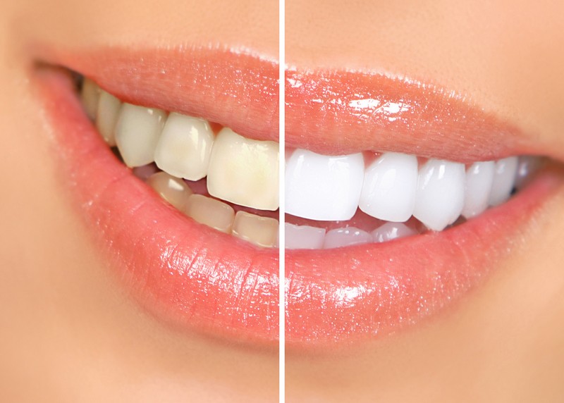 teeth whitening services Framingham, MA